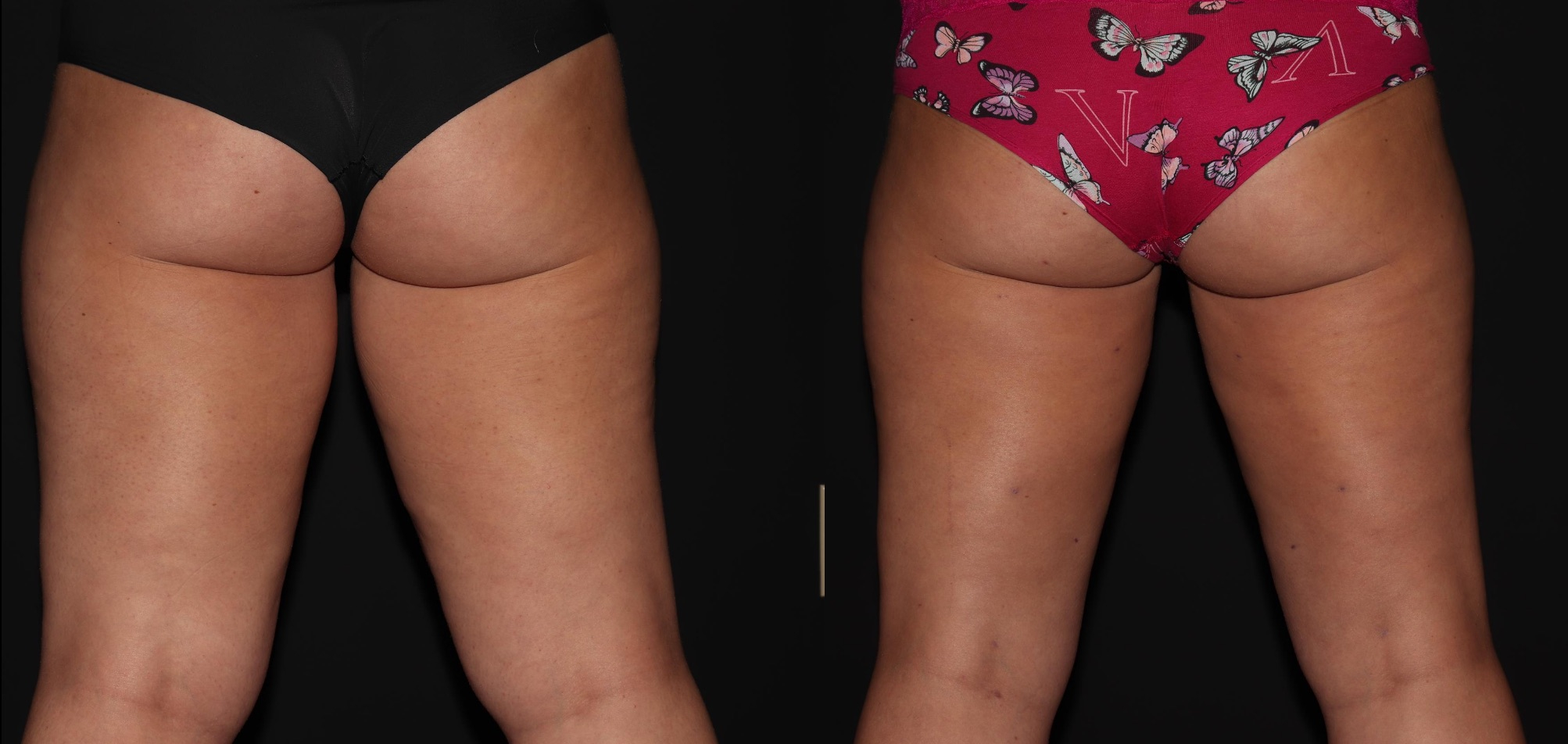 Before and After Image: Liposuction – Thighs - front